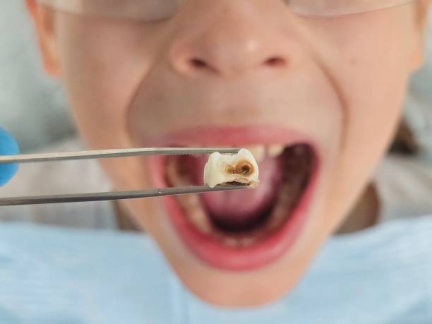Best Emergency Dentist for Lost Fillings or Crowns in Salida, CO
